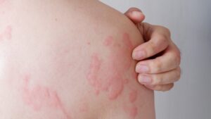Hautausschlag durch Schimmelallergie mit roten Flecken