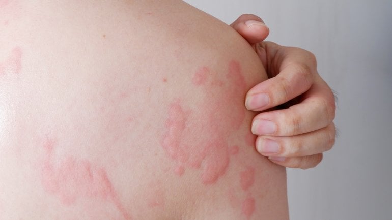 Hautausschlag durch Schimmelallergie mit roten Flecken